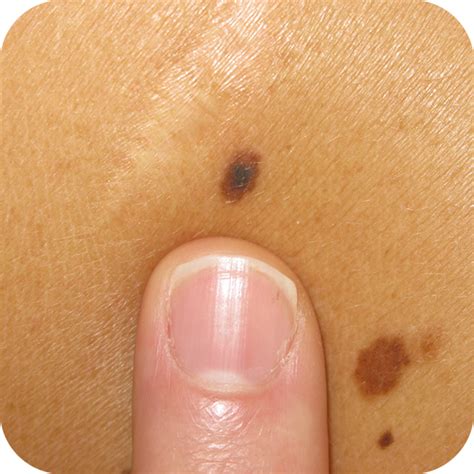 melanoma a diffusione superficiale in situ